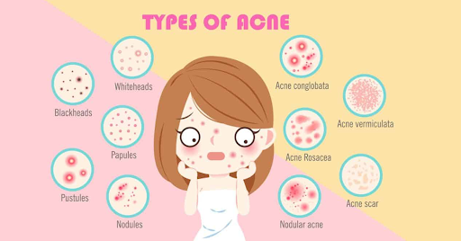 Isotretinoin: आइसोट्रेटिनोइन क्या है? जानिए इसके उपयोग, साइड इफेक्ट्स और सावधानियां