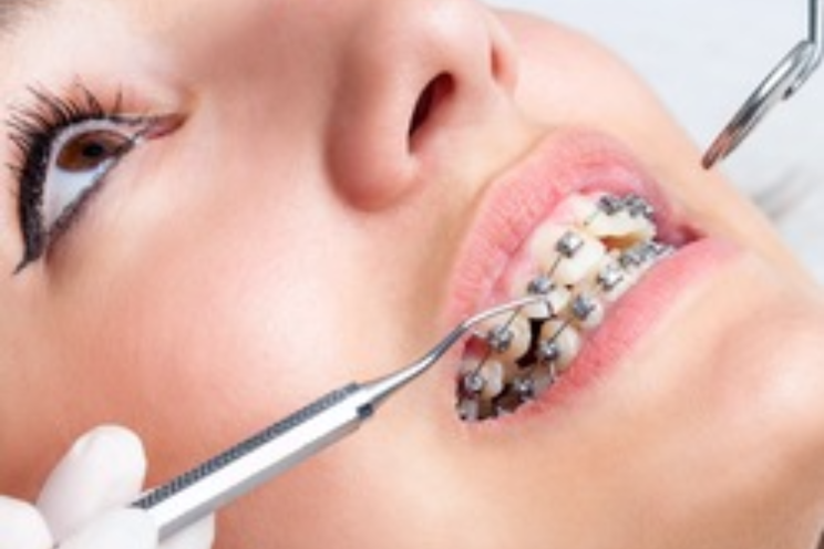 दांतों में ब्रेसेस लगवाने के बाद बचें इन खाद्य पदार्थों के सेवन से