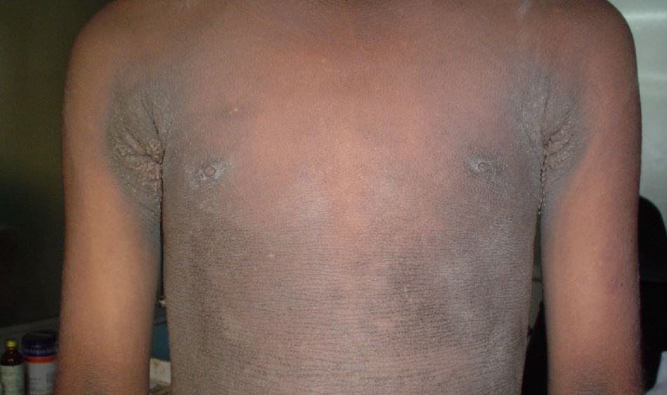 Acanthosis nigricans : एकैंथोसिस निगरिकन्स क्या है?