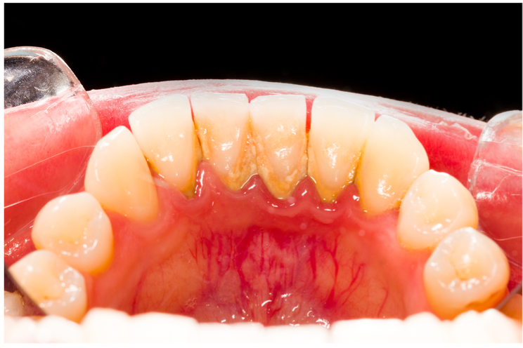 दांतों से टार्टर की सफाई के आसान 6 घरेलू उपाय