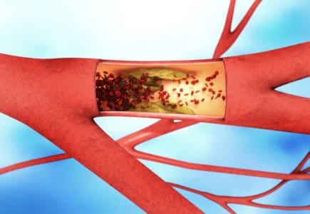 Arterial thrombosis: आर्टेरियल थ्रोम्बोसिस क्या है?