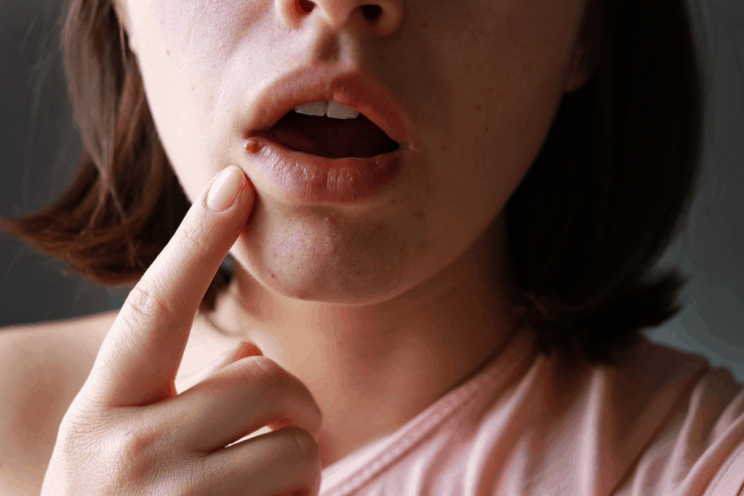 होंठों पर पिंपल्स का इलाज ढूंढ रहे हैं? तो ये आर्टिकल कर सकता है आपकी मदद