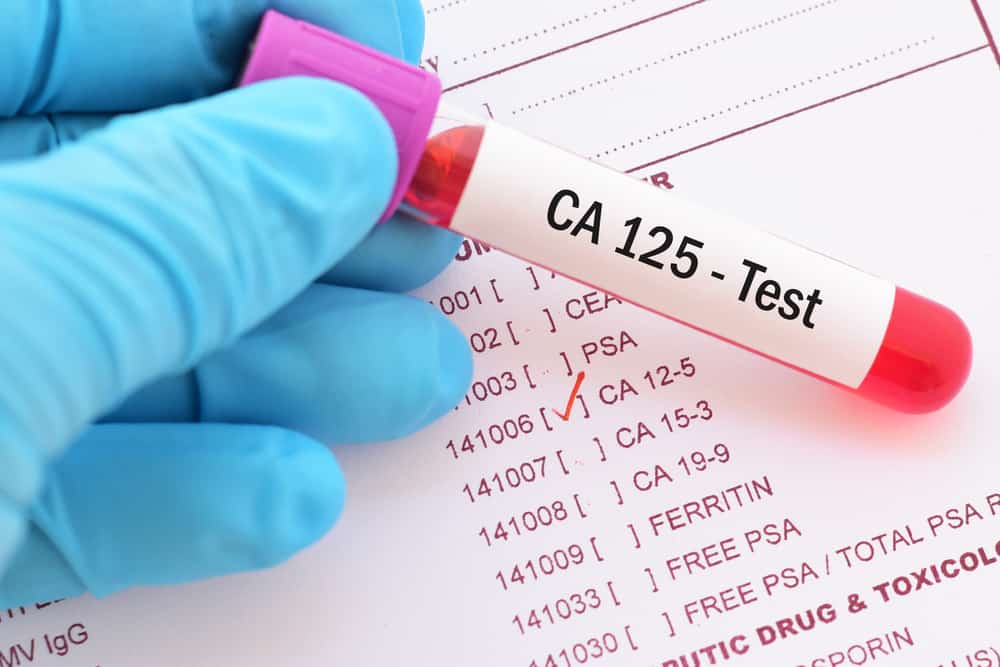 Ca-125 Tumor Marker : सीए 125 ट्यूमर मार्कर टेस्ट क्या है?