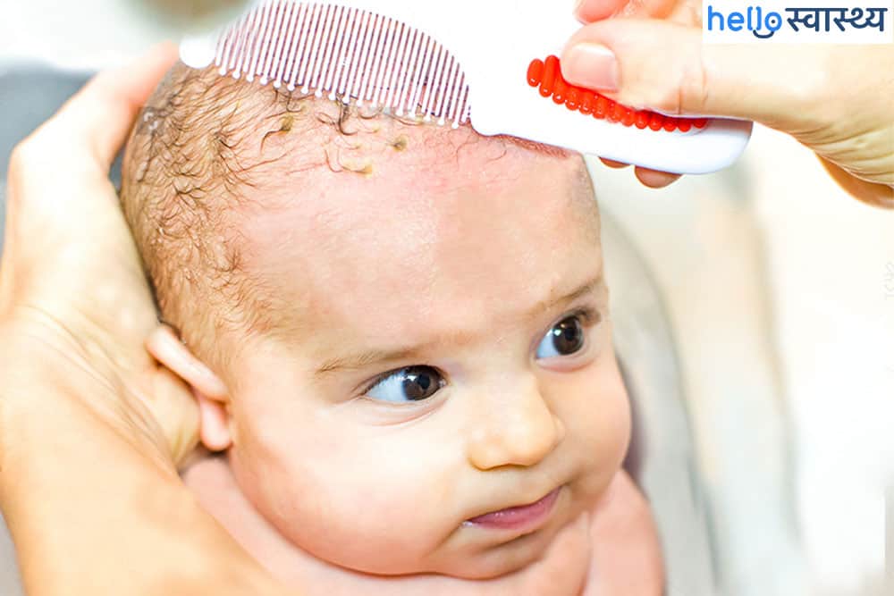 सिर में क्रेडल कैप (सिर में पपड़ी जमना): शिशु के सिर से क्रैडल कैप निकालने का सही तरीका