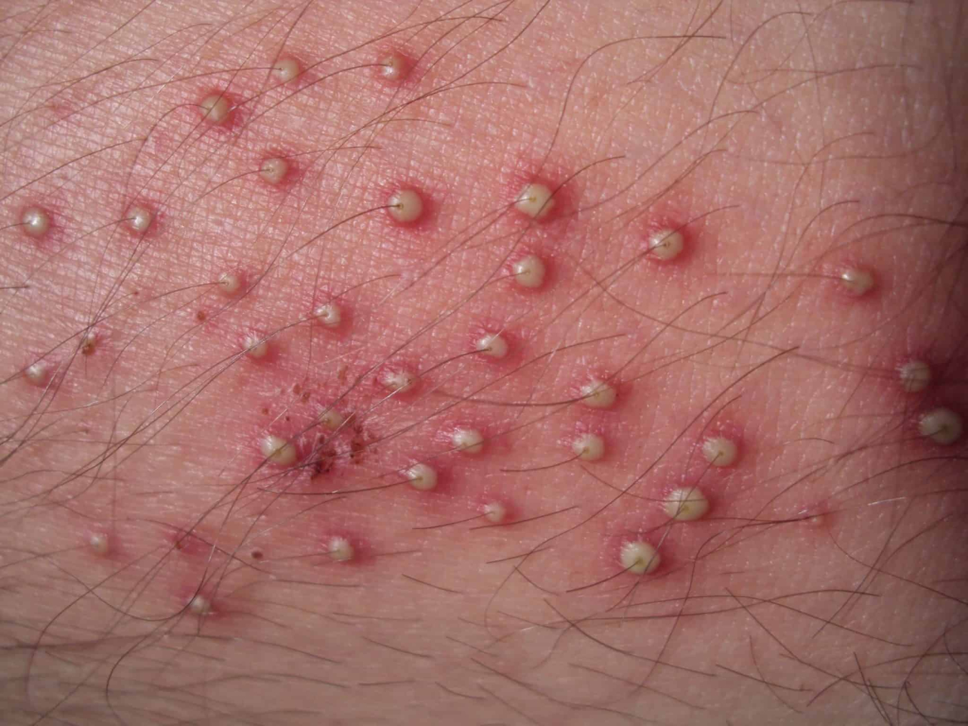 Folliculitis: फॉलिक्युलाइटिस क्या है?