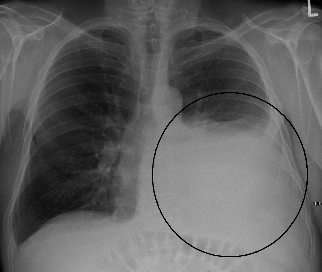 Pleural effusion: प्ल्यूरल इफ्यूजन (फुफ्फुस बहाव) क्या है?