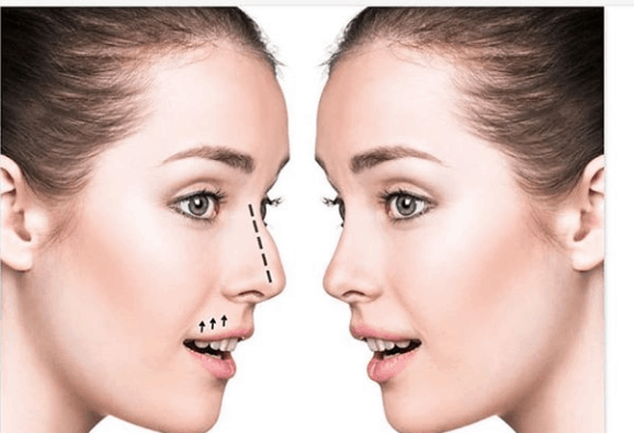 Cosmetic Surgery: कॉस्मेटिक सर्जरी क्या है?