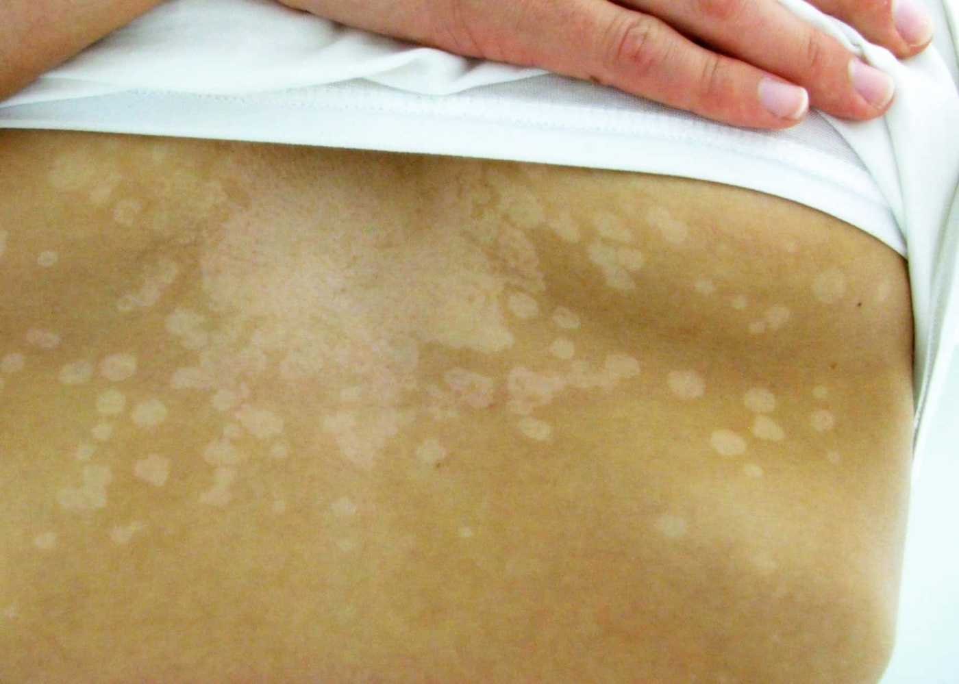 Tinea Versicolor: टिनिया वेर्सिकोलोर क्या है? जानिए इसके कारण, लक्षण और इलाज