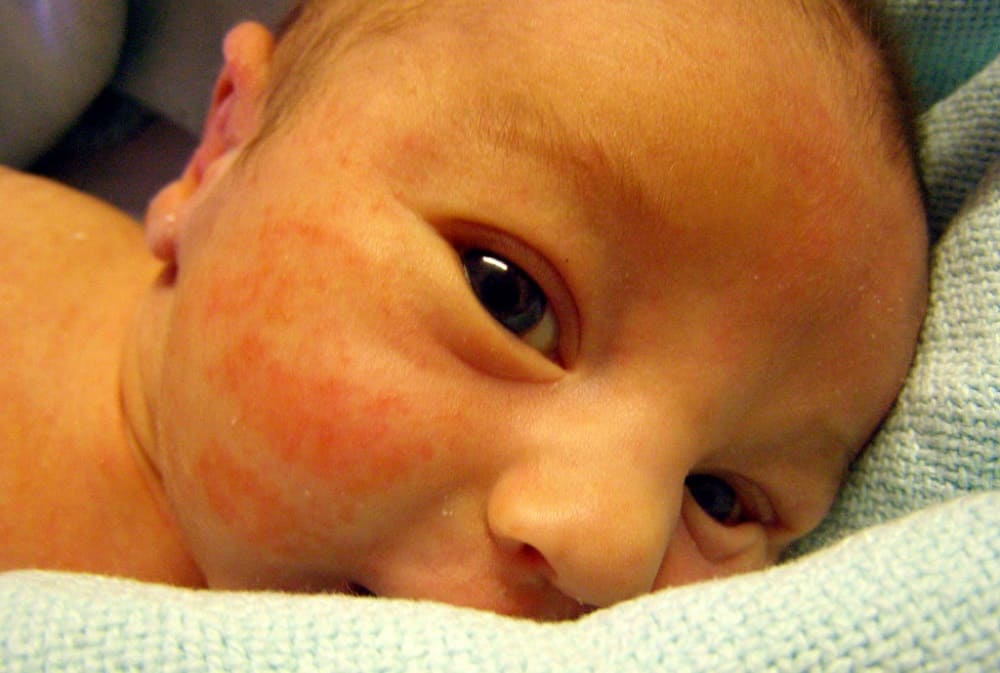 जानें बच्चों में बर्थमार्क के प्रकार और उसके कारण