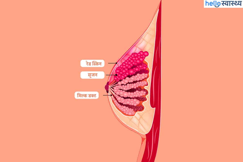 ब्रेस्ट इंफेक्शन (Breast infection) क्या है?
