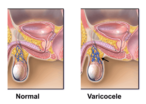 Varicocele: वैरिकोसील क्या है? जानिए इसके कारण, लक्षण और उपचार