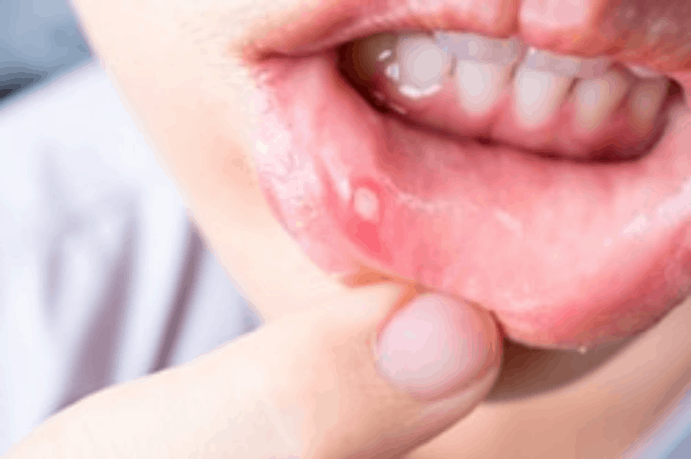 Mouth Infection: जानिए मुंह में संक्रमण के घरेलू उपचार