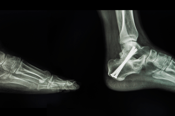 बोन ग्राफ्टिंग (Bone Grafting) क्या है? जानिए इसके प्रकार और जोखिम