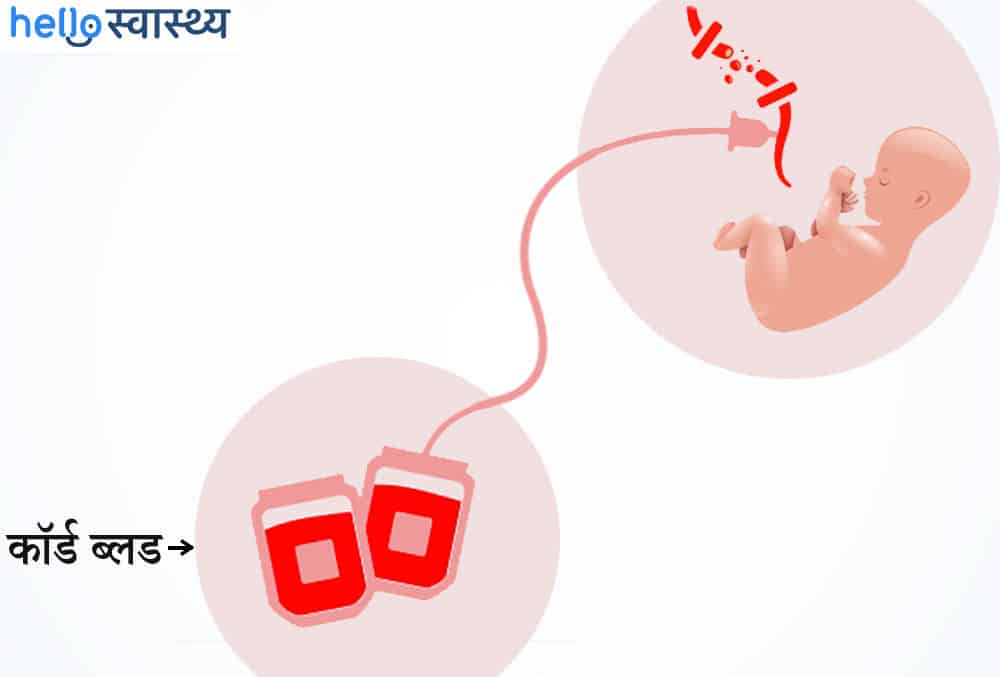 कॉर्ड ब्लड बैंक क्या है? जानें इसके फायदे