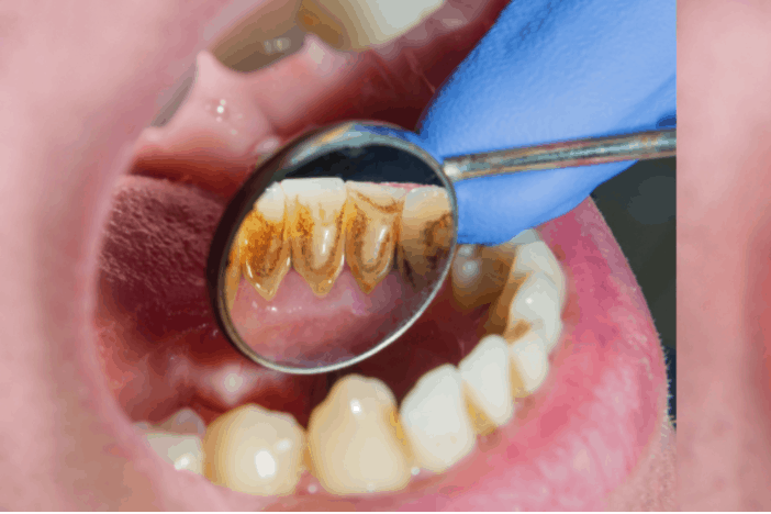 ओरल मेलिग्नेंट मेलेनोमा (Oral Malignant Melanoma) : कैंसर के इस प्रकार के बारे में जानते हैं आप?