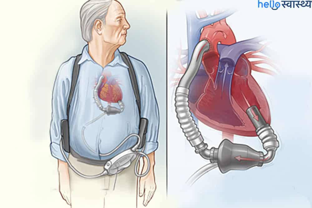 पिछले दस सालों से डूगर के सीने में धड़क रहा है नकली दिल!