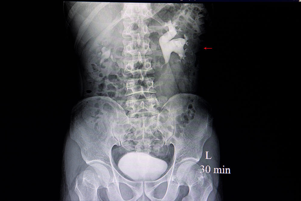 Intravenous Pyelogram: इंट्रावेनस पायलोग्राम टेस्ट क्या है?