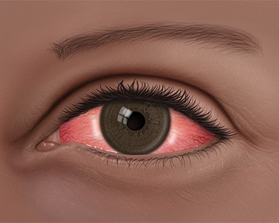 Ocular rosacea: ऑक्यूलर रोजेशिया क्या है?