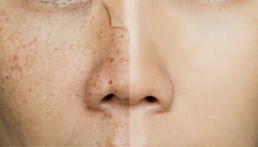 Freckles: फ्रेकल्स (झाई) क्या है? जानिए इसके कारण, लक्षण और उपाय