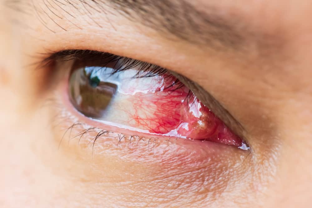 Pterygium: टेरिजियम क्या है ?