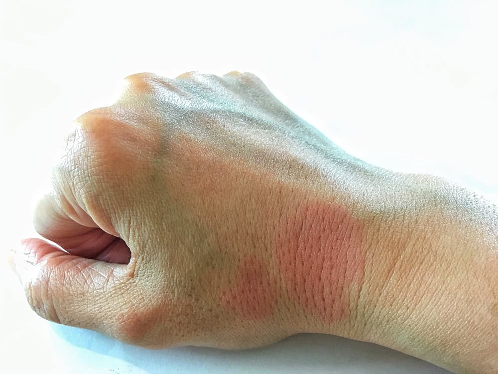 Lupus : ल्यूपस क्या है ?