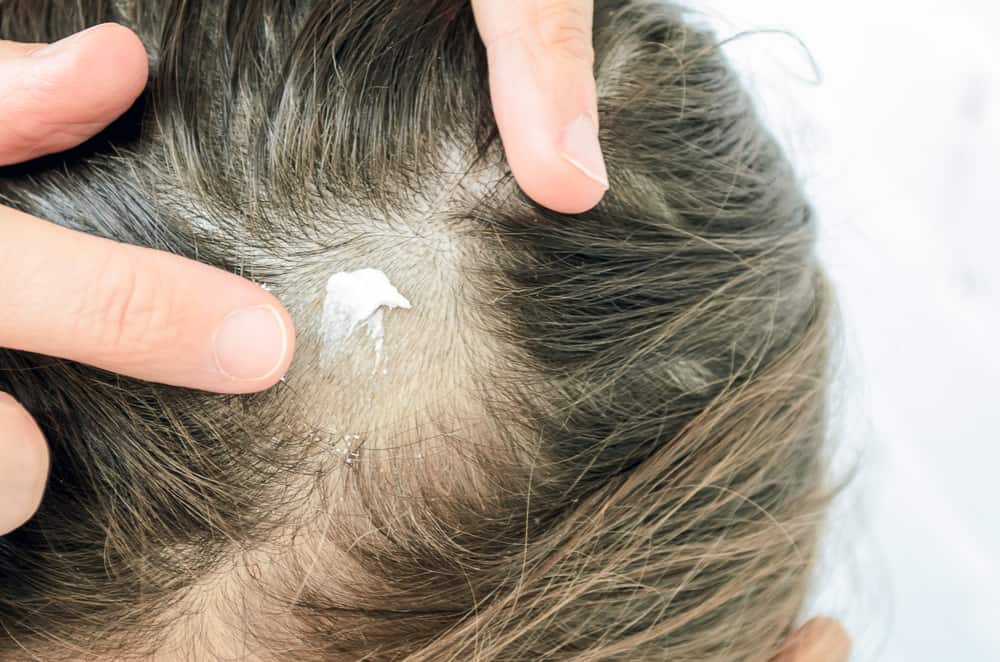 Tinea Capitis & Scalp Ringworm: टीनिया कैपिटिस और स्कैल्प रिंगवर्म क्या है? जानें इसके कारण, लक्षण और उपाय