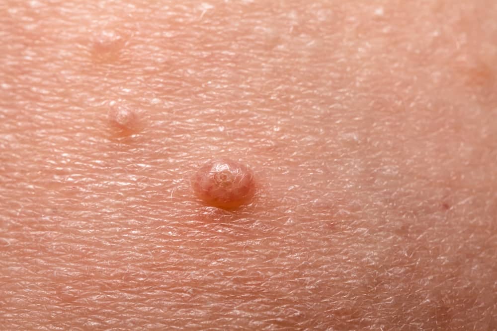Molluscum contagiosum: मोल्लुसकम कंटेजियोसम क्या है?