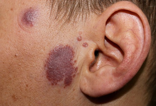 Sarcoidosis: सारकॉइडोसिस क्या है?