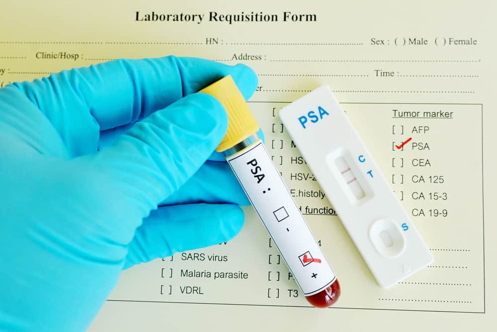 Prostate-Specific Antigen (PSA) Test : प्रोस्टेट एंटीजन टेस्ट क्या है?
