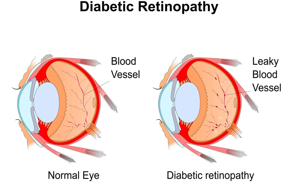 डायबिटिक रेटिनोपैथी - Diabetic retinopathy