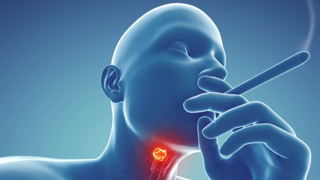 Throat cancer: गले (थ्रोट) का कैंसर क्या होता है? जानें इसके कारण, लक्षण व बचाव