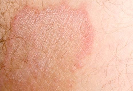 Tinea Cruris : टीनिया क्रूरिस क्या है?