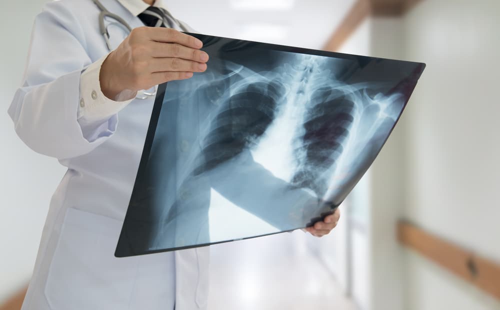 Chest X-Ray: चेस्ट एक्स-रे क्या है?
