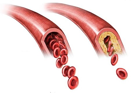 Atherosclerosis: एथेरोस्क्लेरोसिस क्या है?