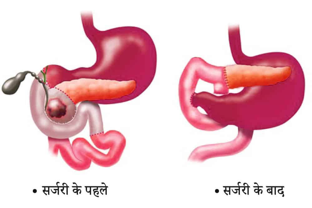 Whipple Procedure: विप्पल प्रोसीजर क्या है?