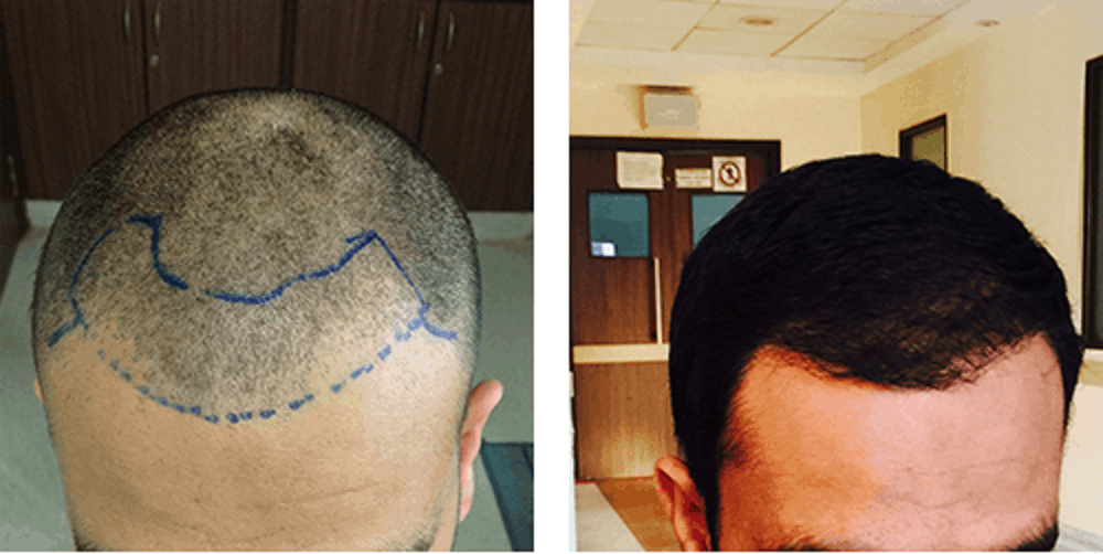 Hair Transplant : हेयर ट्रांसप्लांट कैसे होता है?