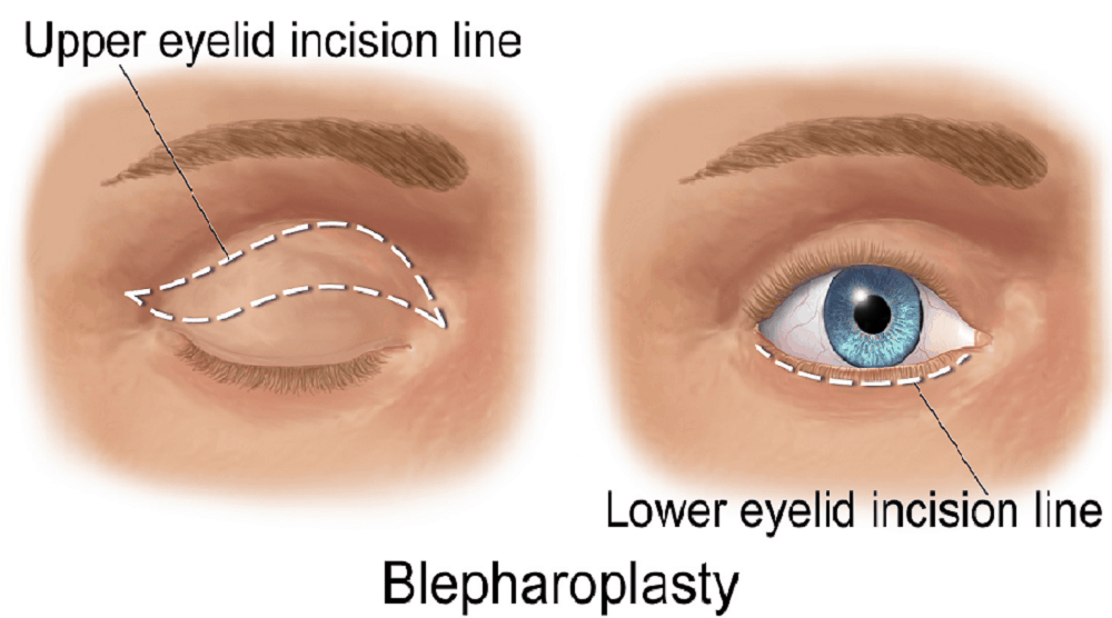 Eyelid Surgery : आइलिड सर्जरी या ब्लेफेरोप्लास्टी क्या है?