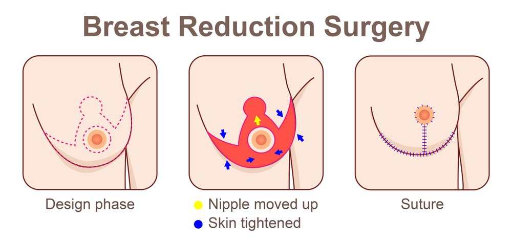 Breast Reduction Surgery: ब्रेस्ट रिडक्शन सर्जरी क्या है?