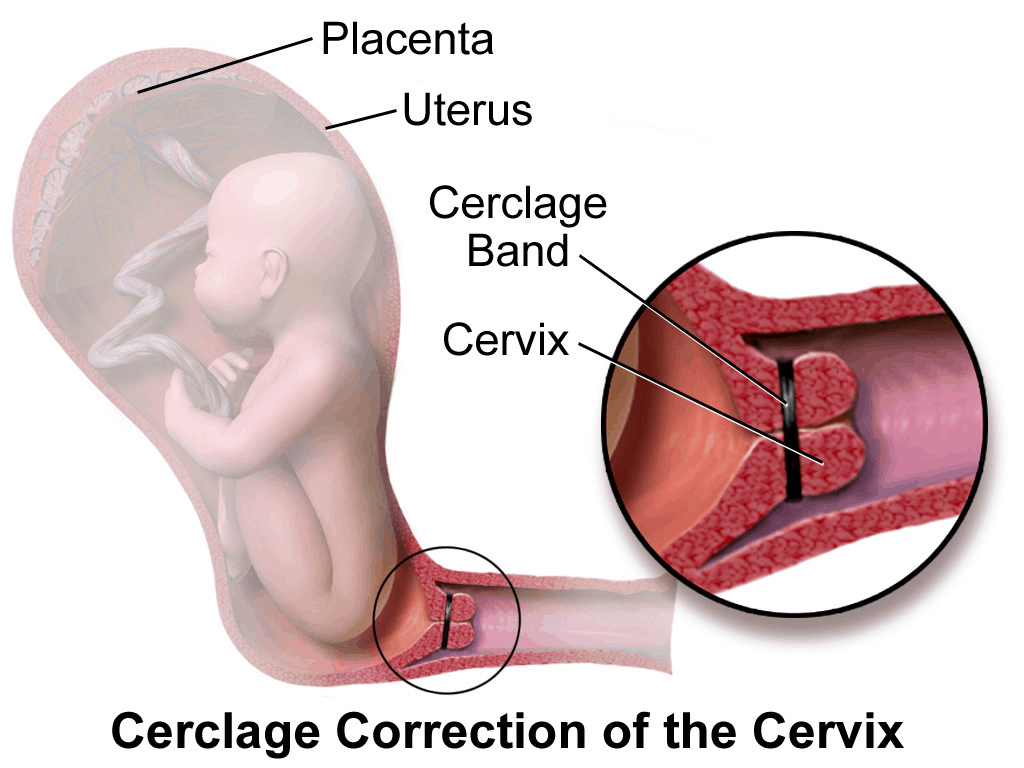 Cervical Cerclage : सर्वाइकल सरक्लेज क्या है?