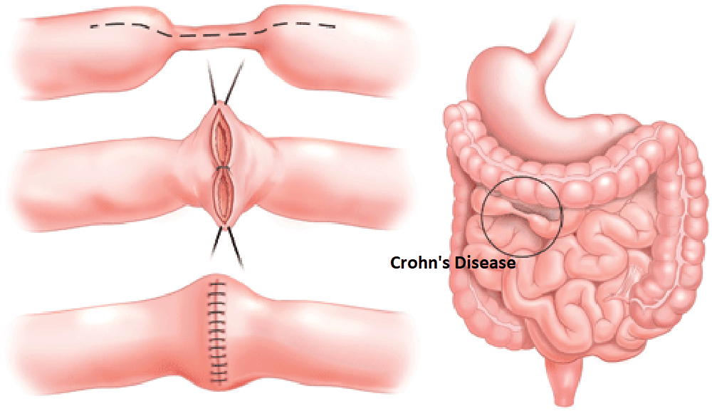 Crohn's disease surgery : क्रॉन्स डिसीज सर्जरी क्या है?