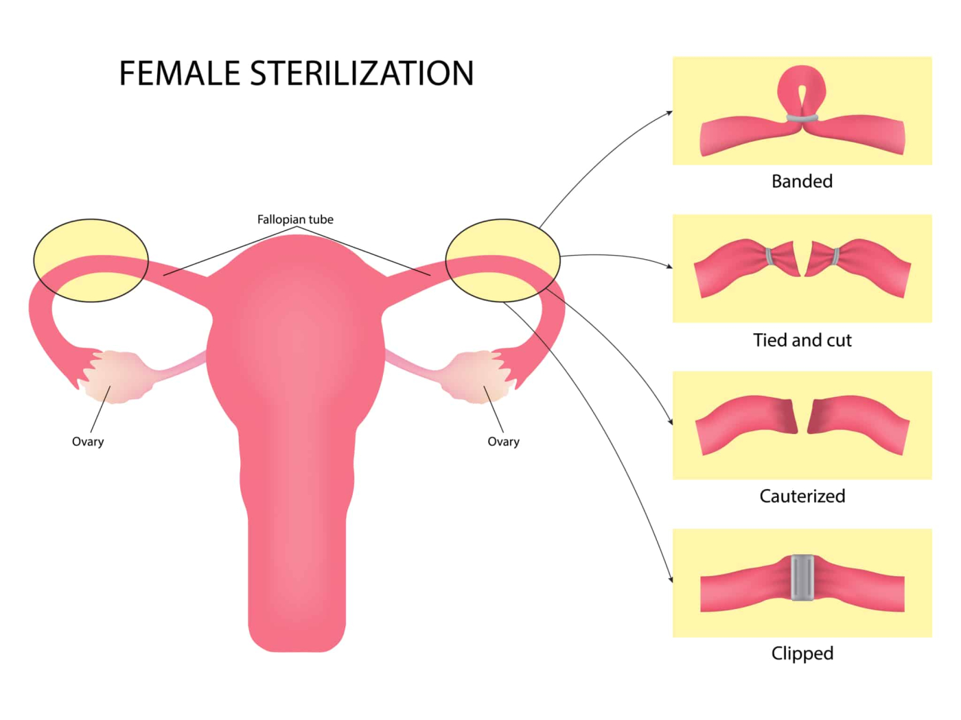 Female Sterilisation : महिला नसबंदी (फीमेल स्टरलाइजेशन) क्या है?