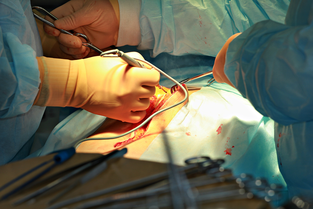 Gastrectomy : गैस्ट्रेक्टमी क्या है?