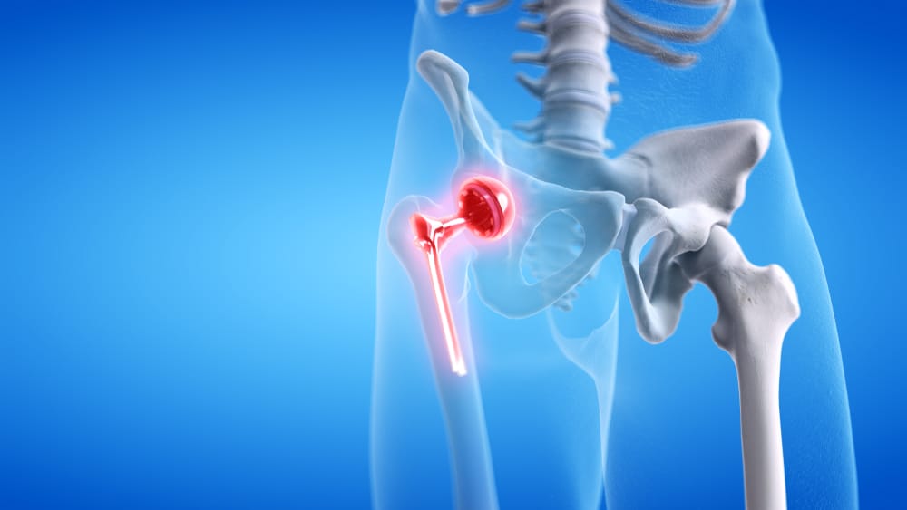 Hip Replacement : हिप रिप्लेसमेंट क्या है?