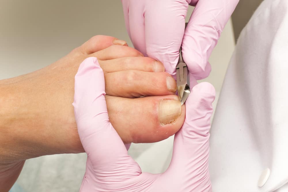 Ingrown Toenail Surgery : इनग्रोन टो नेल सर्जरी क्या है?