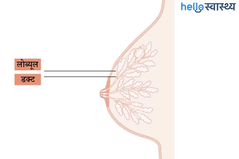 Lobular breast cancer: लोब्यूलर ब्रेस्ट कैंसर क्या है?