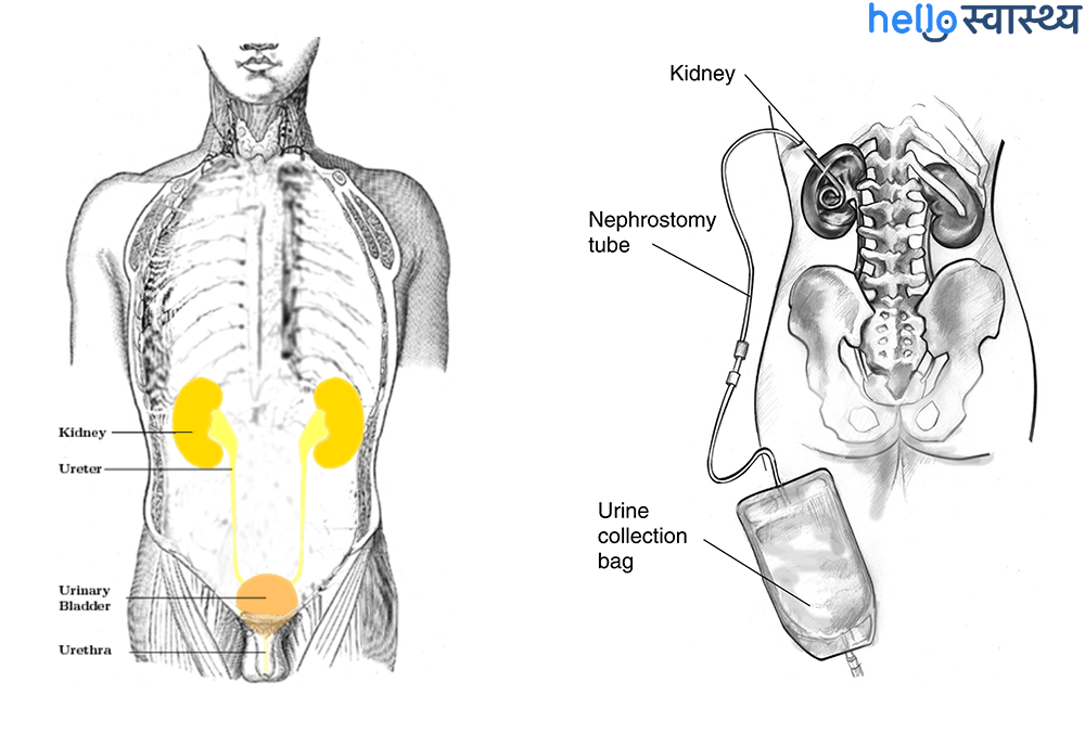 Nephrostomy: नेफ्रोस्टॉमी क्या है?