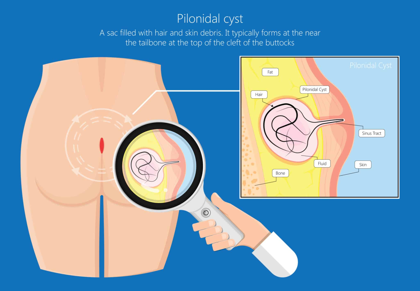 Pilonidal Sinus Surgery : पिलोनिडल साइनस सर्जरी क्या है?