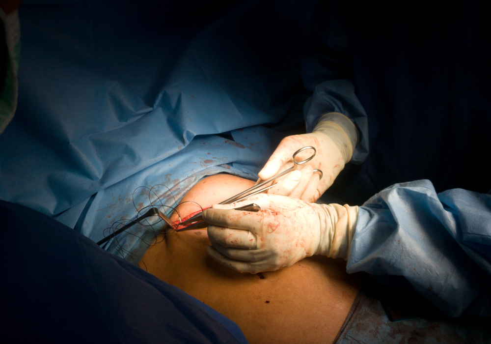 Splenectomy: स्प्लेनेक्टोमी क्या है?