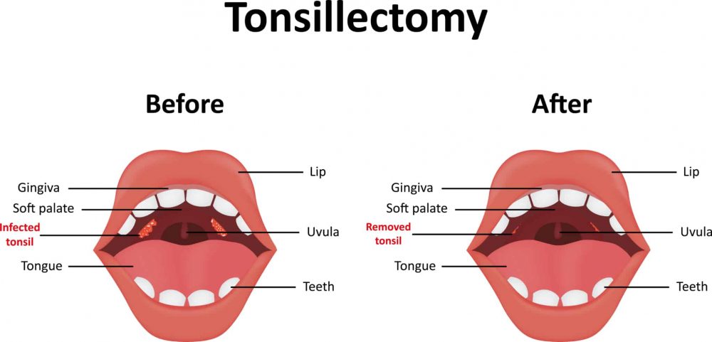 Tonsillectomy : टॉन्सिलेक्टमी क्या है?