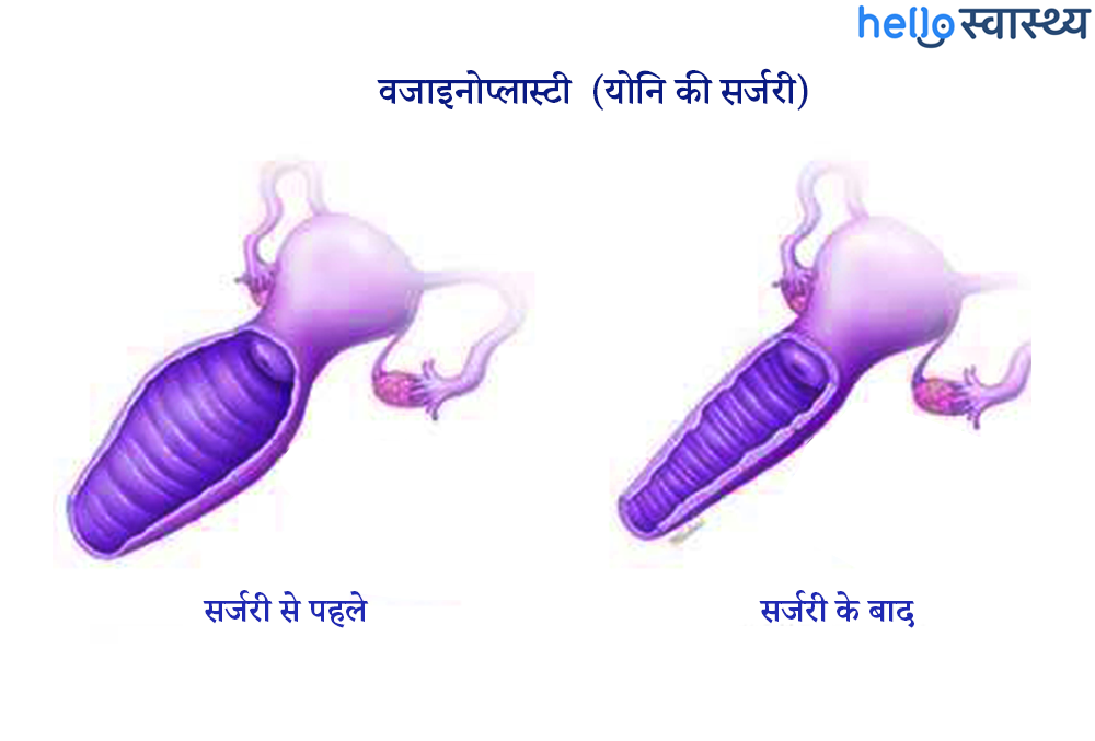 Vaginoplasty : वजाइनोप्लास्टी क्या है?